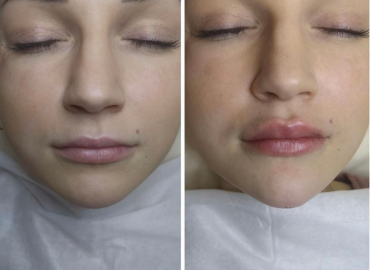 Hyaluronic acid injections for lip plumping